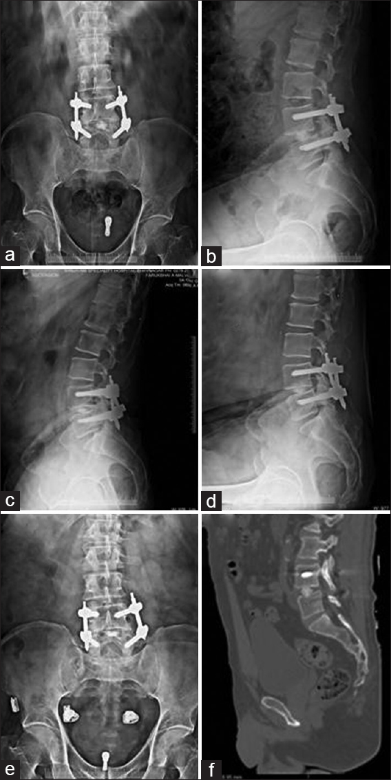 (a and b) Postoperative radiograph anteroposterior and lateral showing good alignment with bone graft and interbody hydroxyapatite (c-e) follow-up flexion/extension lateral and anteroposterior radiograph at 47 months showing stable construct with union and disc height loss of 2 mm. (e and f) Computed tomography scan showing incorporation of the graft across endplate. Preoperative disability significant with an ODI 95.56 that improved to 40.00 at 6 weeks and 35.6 at 47 months postoperative